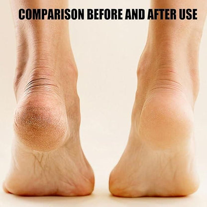 Electronic Pedicure Tool-Salon Soft Feet at Home